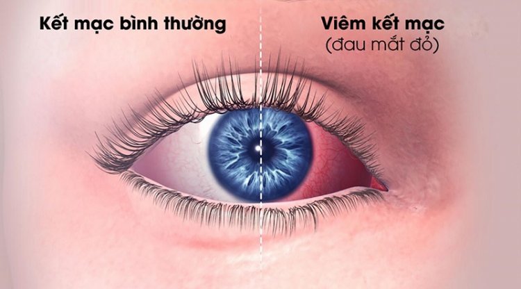 Phòng chống bệnh đau mắt đỏ hiệu quả